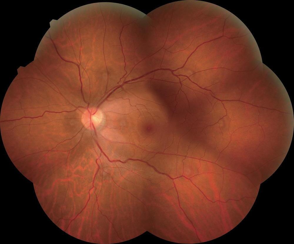 Rétinopathie Diabétique